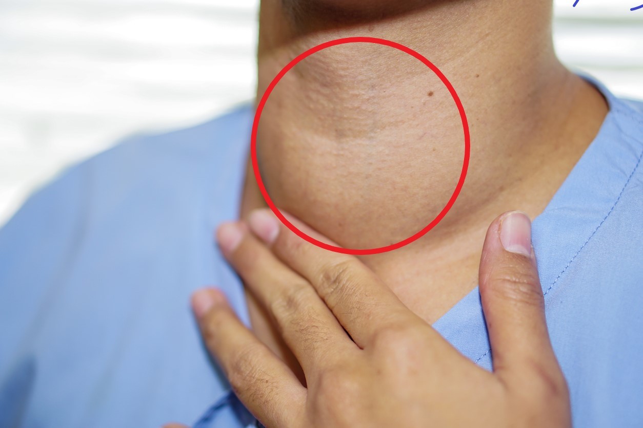 Nódulo en la Tiroides: Síntomas y Tratamientos
